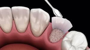 بهبود کاشت و ترمیم دندان با بلوک نانو زیرکونیای ایرانی