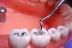 پرکردن دندان با جیوه منسوخ می شود