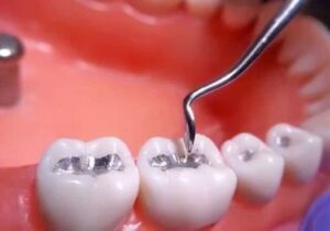 پرکردن دندان با جیوه منسوخ می شود