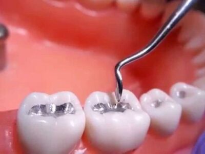 پرکردن دندان با جیوه منسوخ می شود