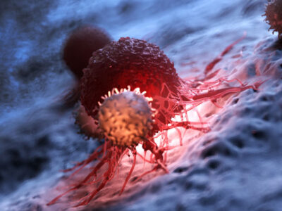 تلاش برای تشخیص سرطان بدون نمونه‌برداری از تومور در دانشگاه تهران