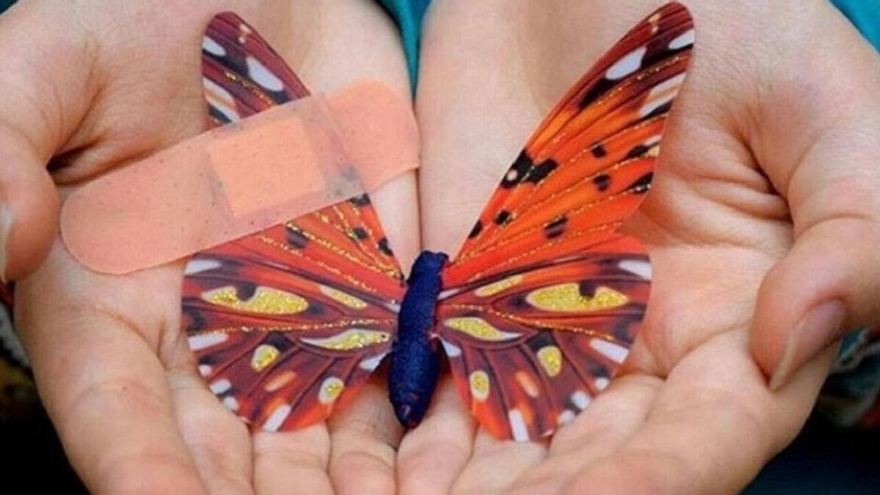 پانسمان ایرانی جایگزین نمونه سوئدی شد؛ در انتظار ۲۸ میلیارد تومان برای نجات بیماران پروانه‌ای